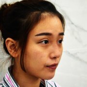 厦门整形隆鼻海峡真实对比图分享：自然够翘 width=