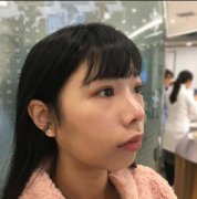淮南华美垫下巴前后对比图：下巴后缩的救星 width=