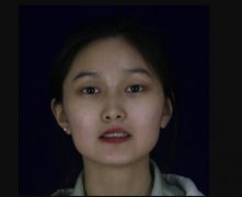 下颌角接骨整形技术亲生体验前后对比案例：浴火重生的人生 width=