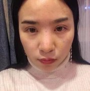 汕头名流整形医院水滴鼻前后对比图皂片 width=