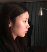 汉密尔顿美容医院韩式隆鼻36天前后对比图皂片 width=