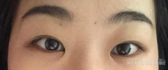 蒙古褶是什么?蒙古褶怎么改良较好呢?