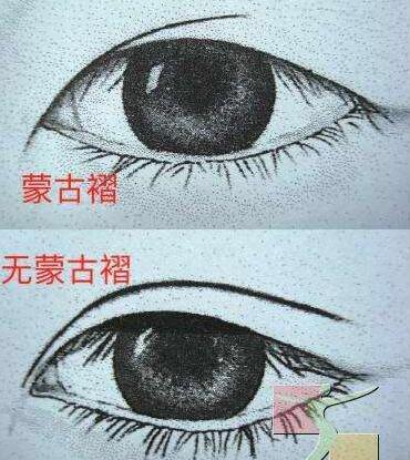 蒙古褶是什么?蒙古褶怎么改良较好呢?