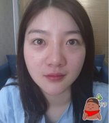 北京软骨隆鼻案例前后对比图：短短58天成女神 width=