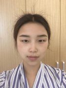 上海真爱整形医院切开双眼皮前后对比图：术后自然很好看 width=
