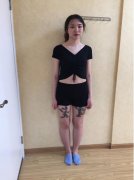吸脂减肥案例分享亲身前后对比图体验 width=