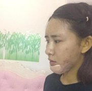 大连艺星整形医院脂肪垫下巴前后对比图：自拍都不用P图了 width=