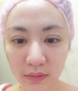 5S重睑术真人案例恢复对比皂片：眼睛真的有变大 width=