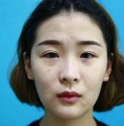 成都华博整形医院切开双眼皮真人案例分享：内附对比图 width=