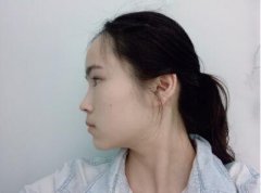鼻梁缩窄64天前后对比图：鼻子的二次发育 width=