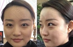 沈阳杏林大西北祛眼袋前后对比图：眼袋老15年 width=