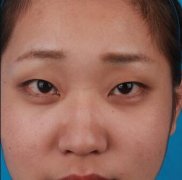 石家庄美联臣双眼皮前后对比图：不看图都不知道是同一个人 width=