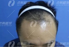 贞韩植发：想植发却不敢来植发，他掉进植发时间陷阱…… width=