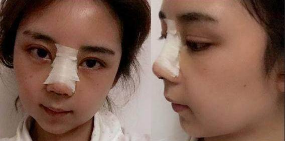 麻麻米亚隆鼻真实案例分享，内附恢复果图