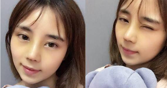 麻麻米亚隆鼻真实案例分享，内附恢复果图