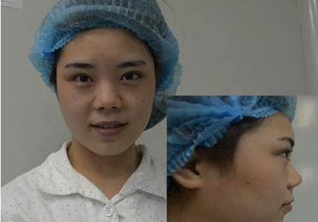 麻麻米亚隆鼻真实案例分享，内附恢复果图