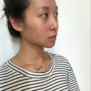 胡琼华双眼皮案例流出，术后果确实还不错~ width=