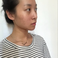 胡琼华双眼皮案例流出，其技术确实厉害!