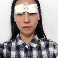 胡琼华双眼皮案例流出，其技术确实厉害!