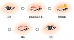 上睑下垂矫正术后护理该咋个做? width=