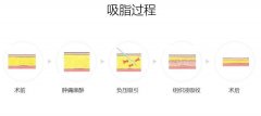 360度环形吸脂有哪些优势？ width=