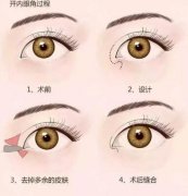 内眦赘皮一定要矫正吗？ width=