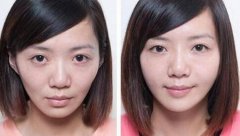 自体脂肪丰面颊果是长久的吗? width=