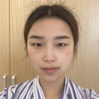 瑷珊下颌角整形案例分享，100天恢复果图展示~~