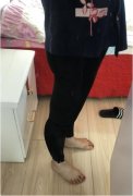 水动力吸脂瘦大腿前后对比皂片：63天甩掉大象腿 width=