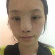 肋骨隆鼻果图前后对比皂片：27岁蜕变 width=