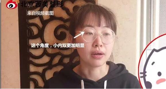 北京西美整形吕薇双眼皮案例又来一则，接住！