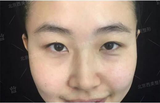 北京西美整形吕薇双眼皮案例又来一则，接住！