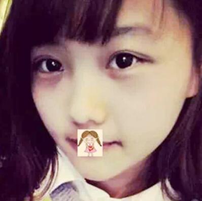 无锡同济整形医院做双眼皮技术怎么样?真实案例流出!