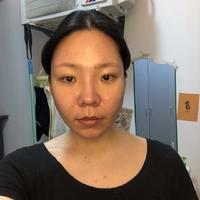 去颊脂垫恢复时间需要多久，真实案例为你揭晓!