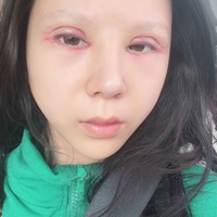 杨继红做的双眼皮果如何?能让我拥有自然的大眼睛吗?