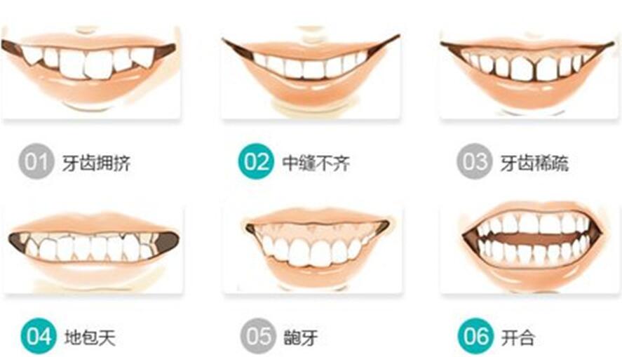女人后缩下颌角整形有后遗症吗?
