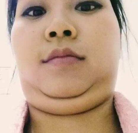 抽脂形体改良怎么做?果好吗?