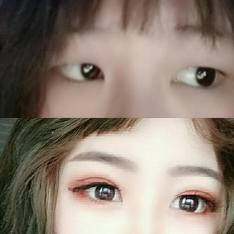 天津做吸雕双眼皮手术大概多少钱?