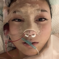 周栩医生做鼻子技术如何?个人案例流出!