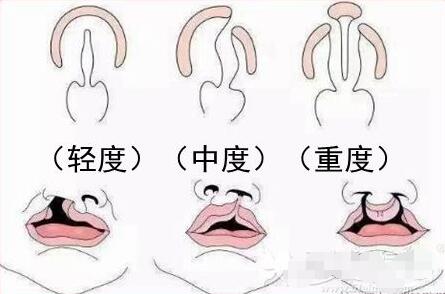 北京调节兔唇的费用大概多少安?贵不贵?
