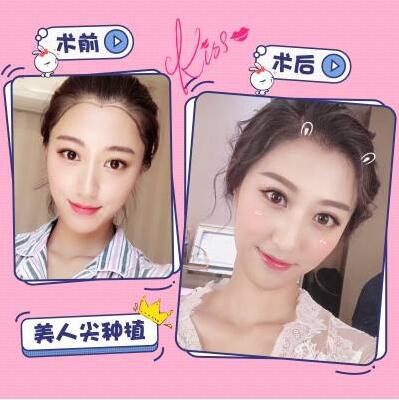 植发美人尖价格多少?大致在什么范围?