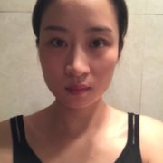 俞良钢颧骨内推案例分享，俞良钢的技术就是这么6~~~ width=