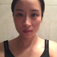 俞良钢颧骨内推案例分享，俞良钢的技术就是这么6~~~