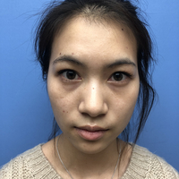 重庆当代整形做双眼皮好不好?能值得信赖吗?