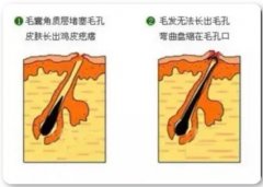 露肉季节，肌肤疙疙瘩瘩不美观怎么办？ width=