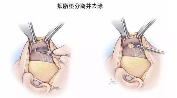 杭州去颊脂垫价格大约多少呢?请帮我看看!