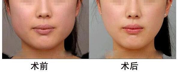 杭州去颊脂垫价格大约多少呢?请帮我看看!
