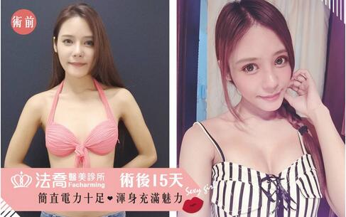 盛宗顺医生做双眼皮怎么样？一起来看看这篇案例吧！
