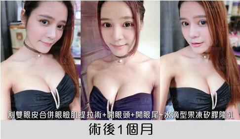 盛宗顺医生做双眼皮怎么样？一起来看看这篇案例吧！