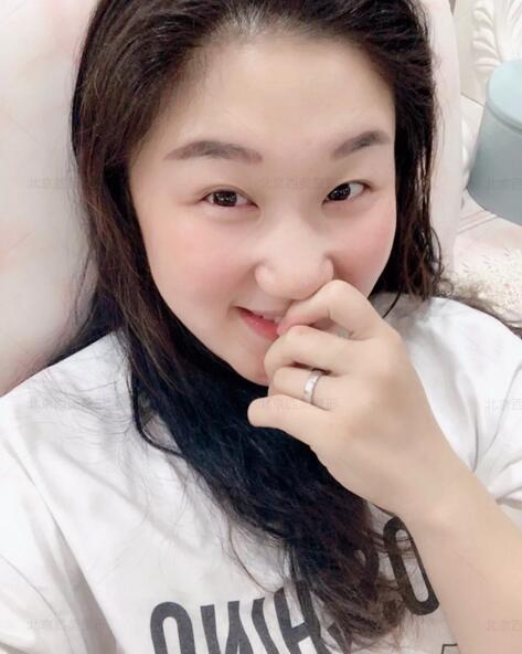北京西美医院靠谱吗？来看看刘野院长做的双眼皮案例哇！